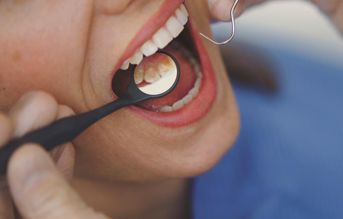 Hygienist checking for plaque on the back molars.