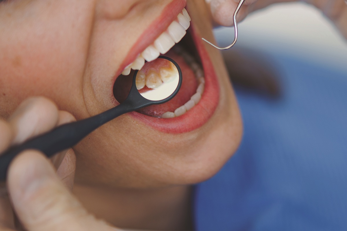 Hygienist checking for plaque on the back molars.